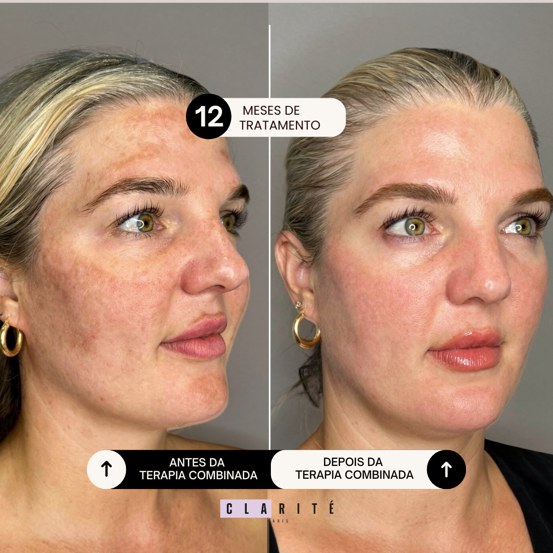 Clarité Caps Anti-Melasma 12 meses | 360 cápsulas